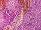 GIST – diagnostyka i leczenie