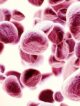 Ultrarzadka nocna napadowa hemoglobinuria