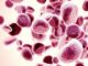 Ultrarzadka nocna napadowa hemoglobinuria