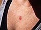 plaster na raka, skinject