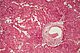 amyloidozy